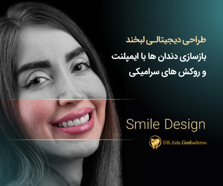 بازسازی دندان ها با ایمپلنت و روکش های سرامیکی